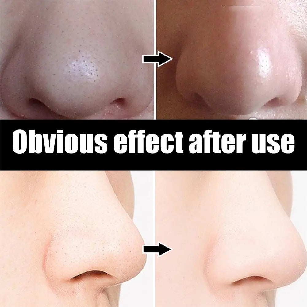 Blackhead Remover Nose Strips