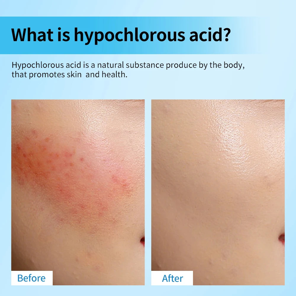 Hypochlorous Acid Facial Spray